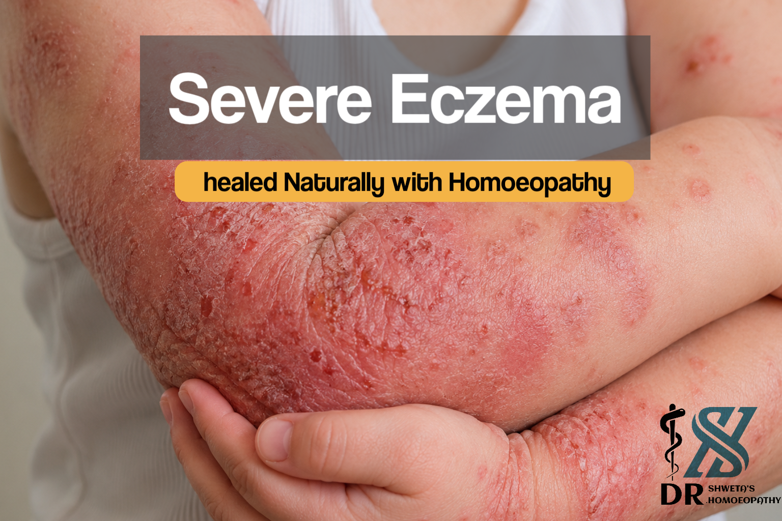 Severe Eczema Healed Naturally with Homoeopathy: A 2-Year Remote Treatment Success Story